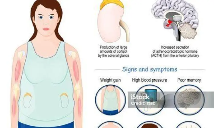 Efek Samping Steroid Ilustrasi gejala sindrom cushing akibat steroid