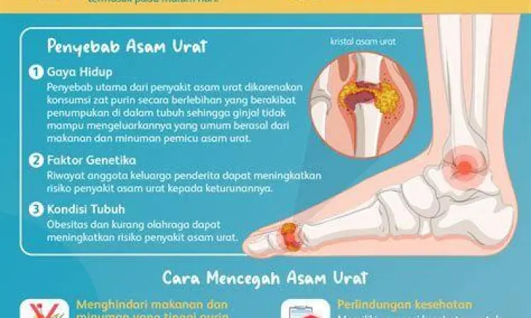 Visualisasi Serangan Asam Urat Gejala pembengkakan sendi akibat kristal asam urat