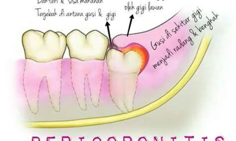 Ilustrasi Gusi Bengkak Anatomi gusi yang mengalami peradangan dan pembengkakan