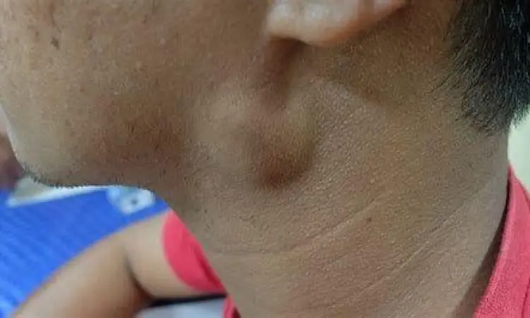 Ilustrasi benjolan pada leher akibat pembengkakan kelenjar