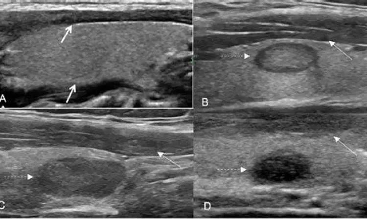 pemeriksaan usg pada nodul tiroid