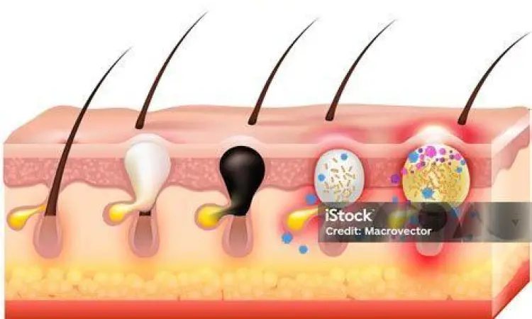 Ilustrasi anatomi pori-pori kulit yang tersumbat penyebab jerawat