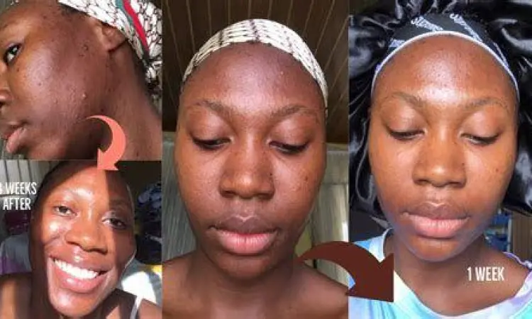 Hasil Penggunaan Kojie San Perbandingan sebelum dan sesudah penggunaan sabun Kojie San