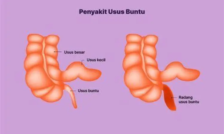 pasien sedang beristirahat setelah operasi apendektomi