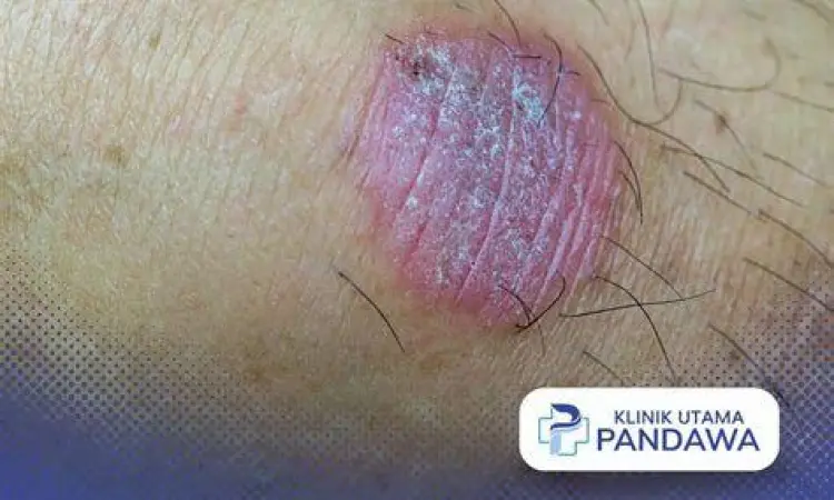 Penyebab Gatal Selangkangan Visualisasi infeksi jamur tinea cruris pada kulit