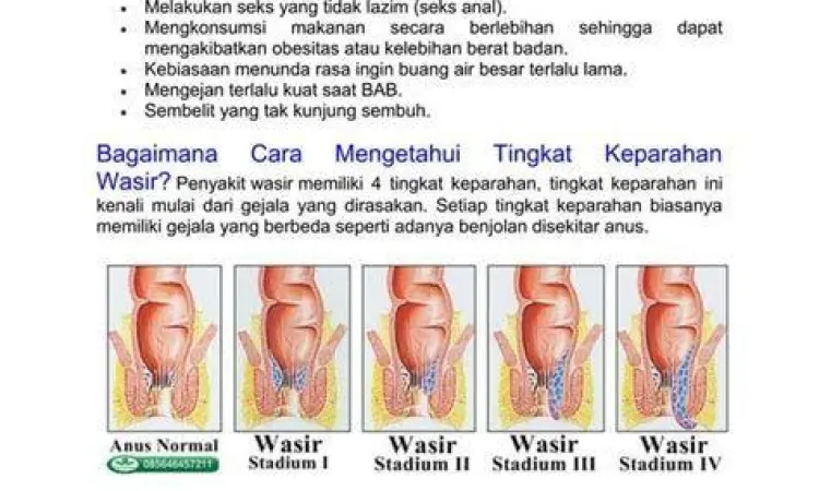 Stadium Ambeien Diagram stadium ambeien dari tahap 1 sampai 4