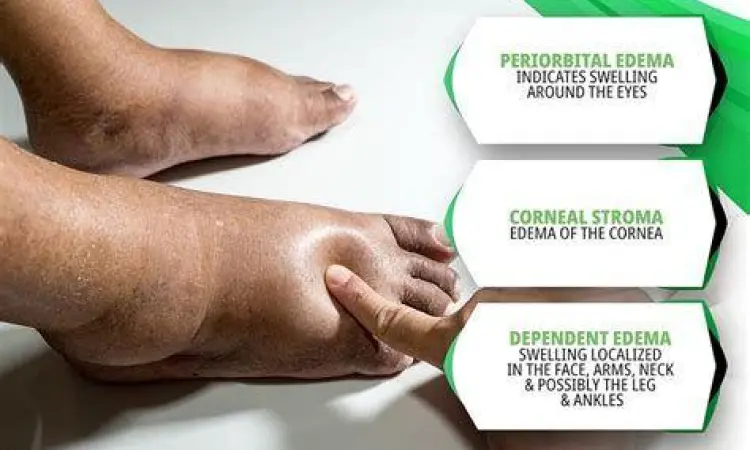 Kondisi kaki bengkak atau edema yang diobati dengan furosemide