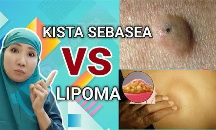 Perbedaan Lipoma dan Kista Perbandingan tekstur lipoma dan kista pada kulit