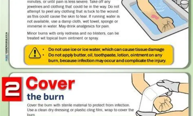 Pertolongan Pertama Luka Bakar pertolongan pertama luka bakar air mengalir