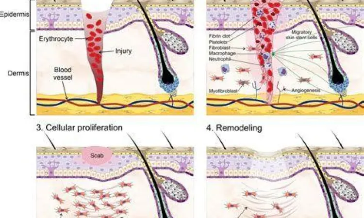 Pemulihan Jaringan Kulit proses regenerasi kulit setelah luka bakar