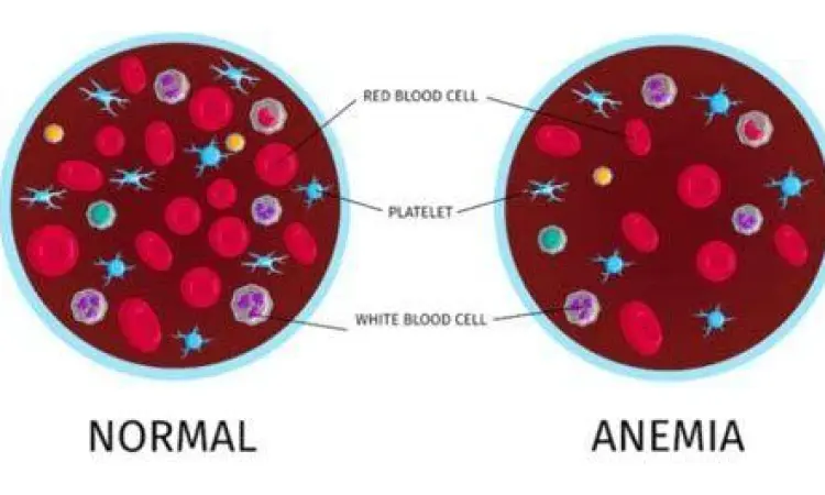 Gejala utama kekurangan darah merah atau anemia