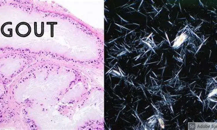 Kristal asam urat di bawah mikroskop pada sendi