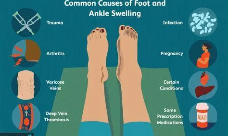 Pembengkakan kaki atau edema yang memerlukan furosemide