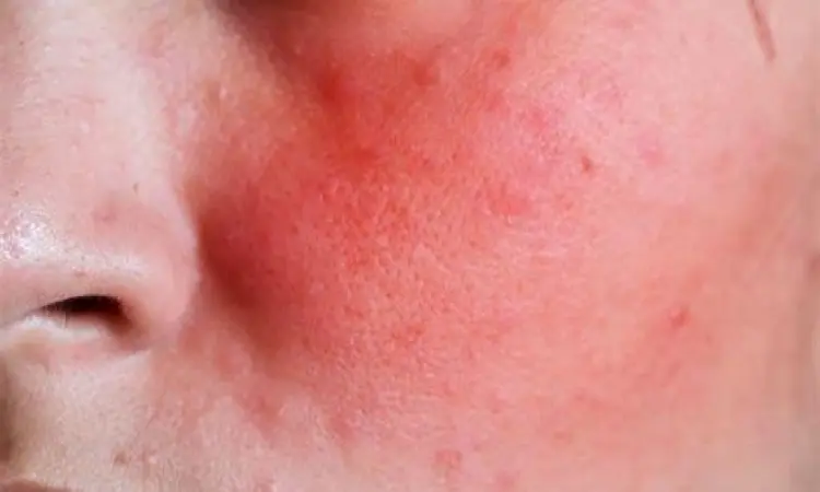 Tampilan kulit wajah yang mengalami kemerahan akibat skin barrier rusak