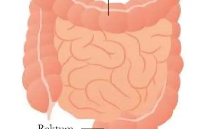 Lokasi Apendiks Letak anatomi usus buntu pada tubuh manusia