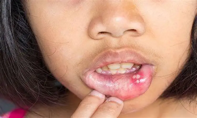 Penyebab Sariawan Infografis penyebab sariawan pada rongga mulut