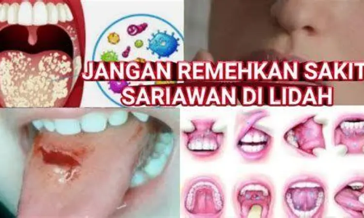 Ilustrasi penyebab sariawan di lidah akibat trauma mekanis