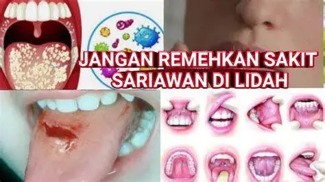 Penyebab Sariawan Ilustrasi penyebab sariawan di lidah akibat trauma mekanis