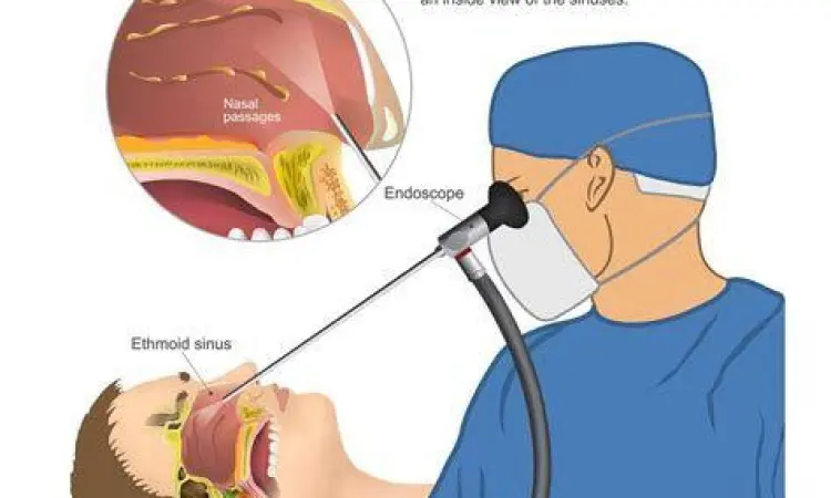 Layanan Endoskopi Hidung Prosedur endoskopi hidung di klinik THT