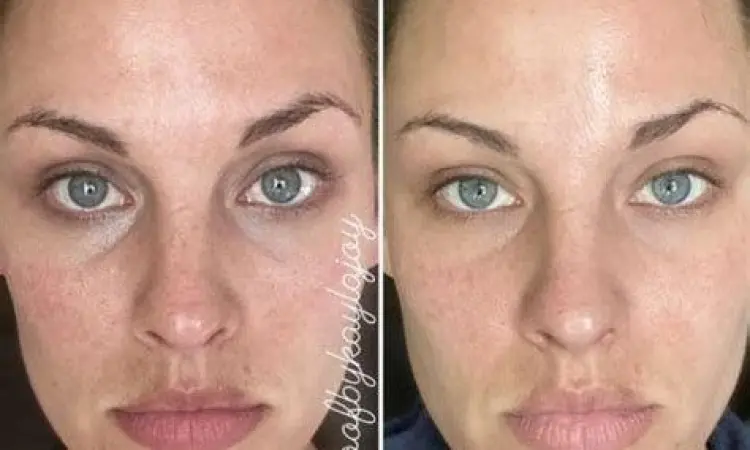 Perbandingan kulit sebelum dan sesudah menggunakan retinol untuk jerawat