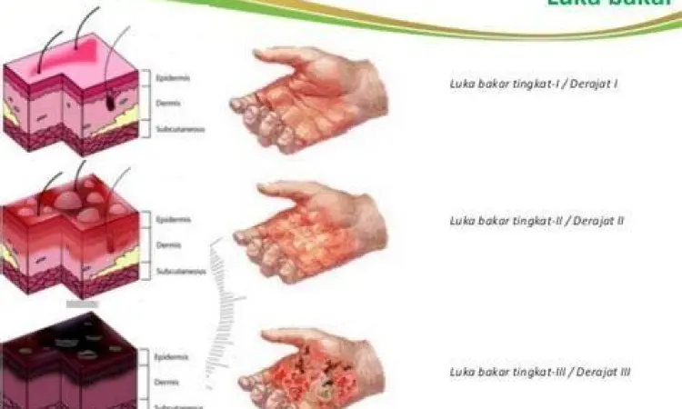 Visualisasi Derajat Luka Bakar Perbedaan tingkatan luka bakar pada lapisan kulit