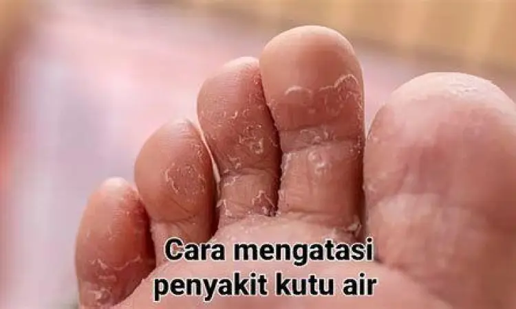 Gejala kutu air yang tampak memerah dan mengelupas di sela jari kaki