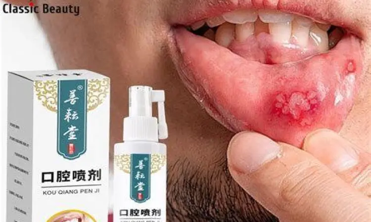 Aplikasi obat semprot pada sariawan mulut