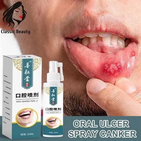 Cara Kerja Obat Semprot Mulut Aplikasi obat semprot pada sariawan mulut