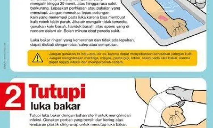 Cara mendinginkan luka bakar dengan air mengalir