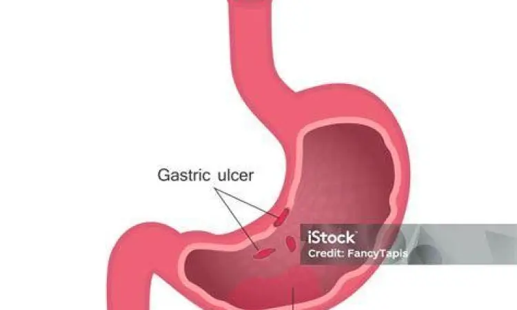 Diagram perbedaan gastritis dan tukak lambung