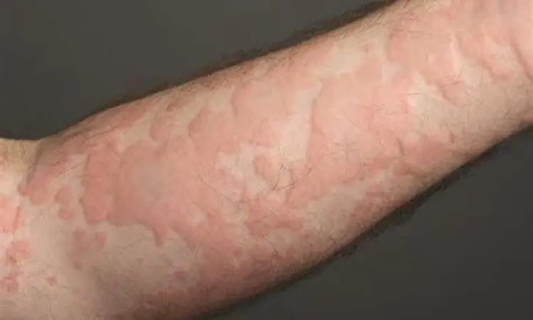 gejala biduran yang gatal