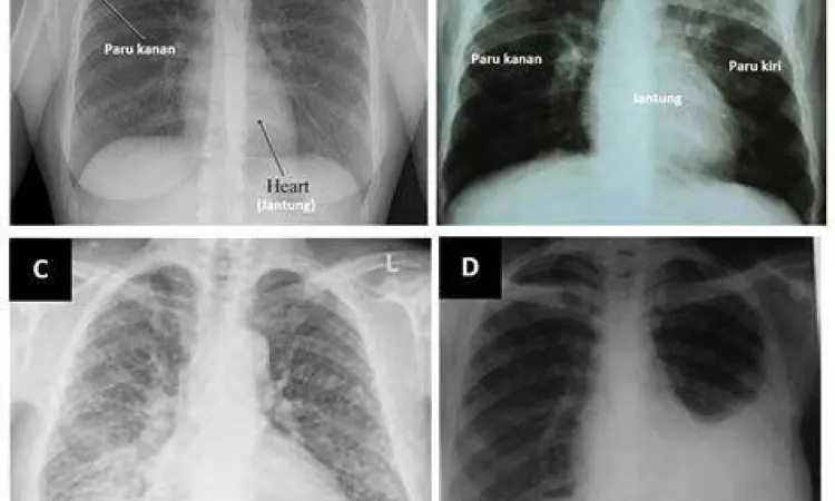 Hasil rontgen dada menunjukkan tanda infeksi tbc