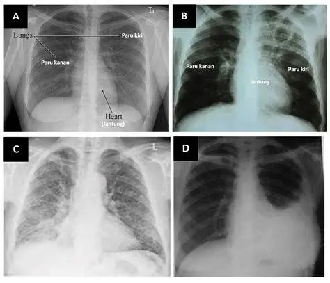 Diagnosis Medis TBC Hasil rontgen dada menunjukkan tanda infeksi tbc