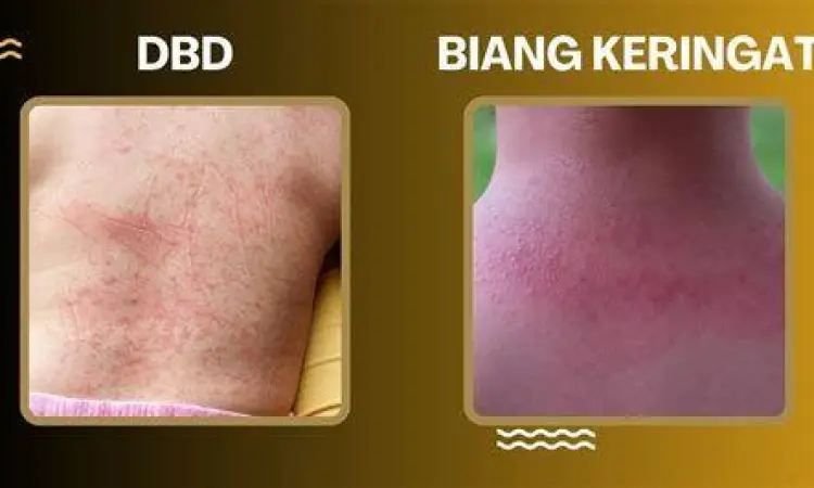 Bintik merah DBD atau petekie pada kulit