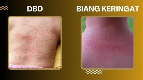 Karakteristik Petekie DBD Bintik merah DBD atau petekie pada kulit