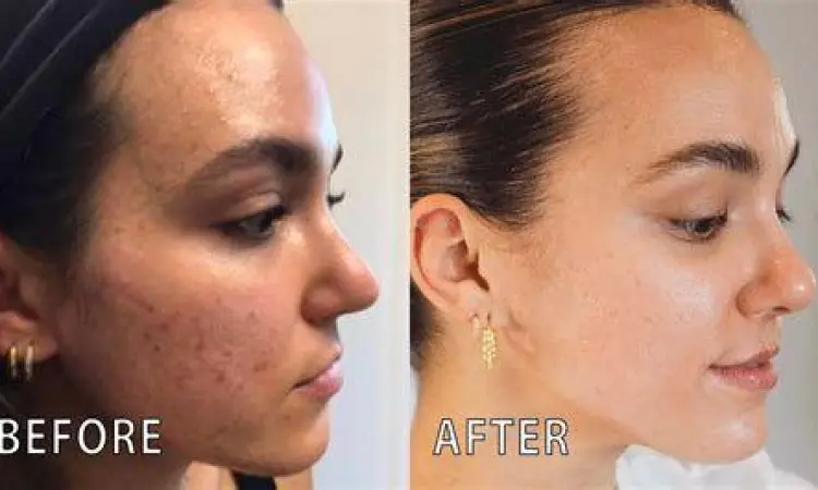 Efek Yasmin pada Kulit Ilustrasi perbaikan kondisi kulit berjerawat