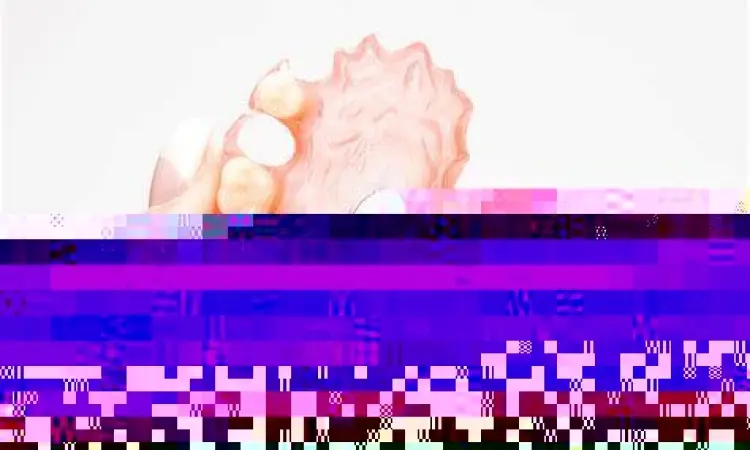 Perbandingan jenis gigi palsu akrilik dan valplast