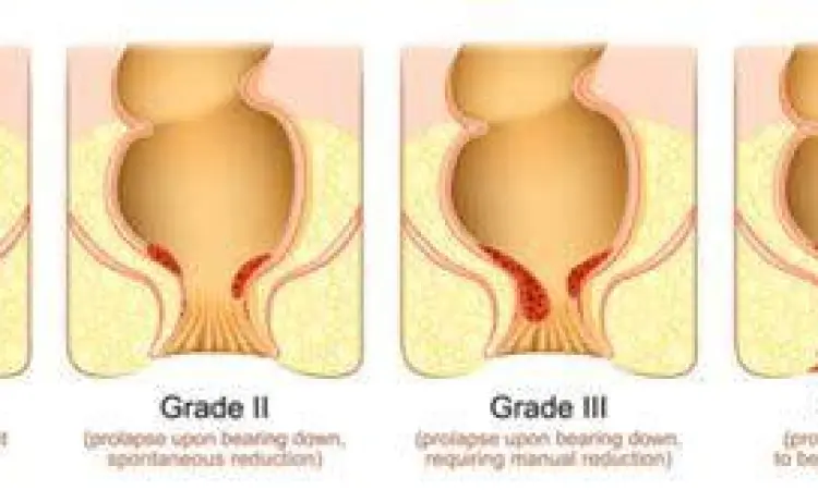 Visualisasi wasir internal stadium awal