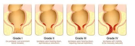 Ambeien Internal Ringan Visualisasi wasir internal stadium awal