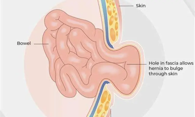 mekanisme terjadinya hernia abdominal