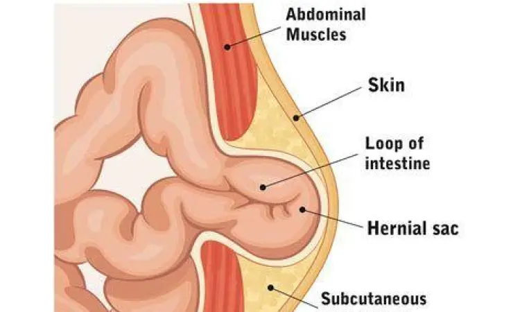 gejala benjolan hernia pada perut