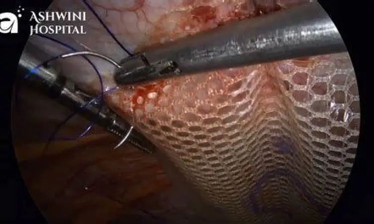 prosedur operasi hernia laparoskopi