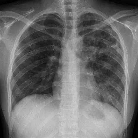 Rontgen Dada TBC Hasil rontgen dada pasien dengan flek paru TBC