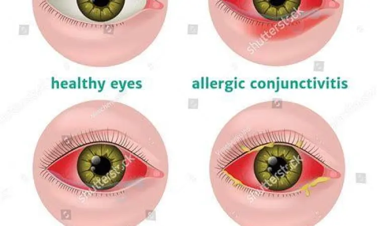 Perbedaan infeksi mata bakteri dan virus