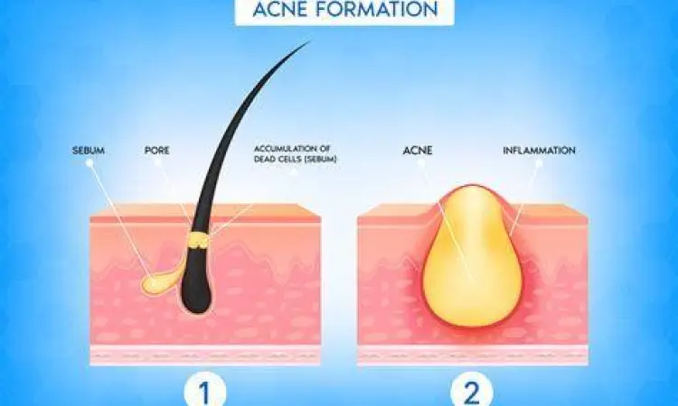 Mikroskopis Pori Tersumbat Pori-pori tersumbat penyebab breakout