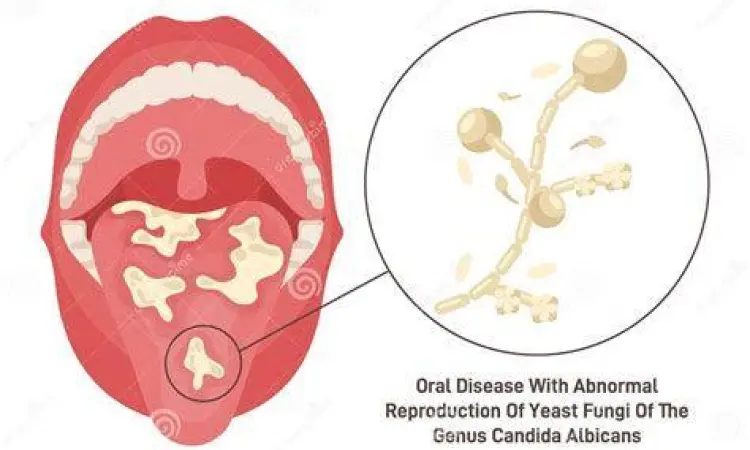 Infeksi Candida Albicans Infeksi ragi akibat pertumbuhan berlebih jamur candida