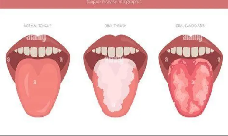 Oral Thrush Candida Gejala oral thrush pada lidah akibat candida