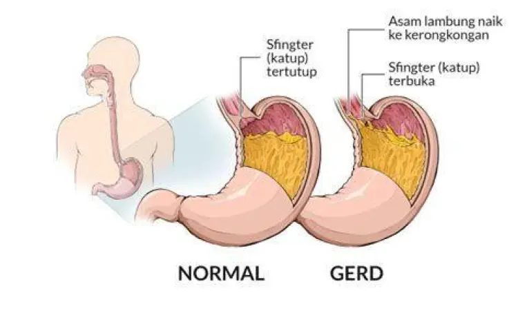 Anatomi lambung manusia dan fungsi katup LES