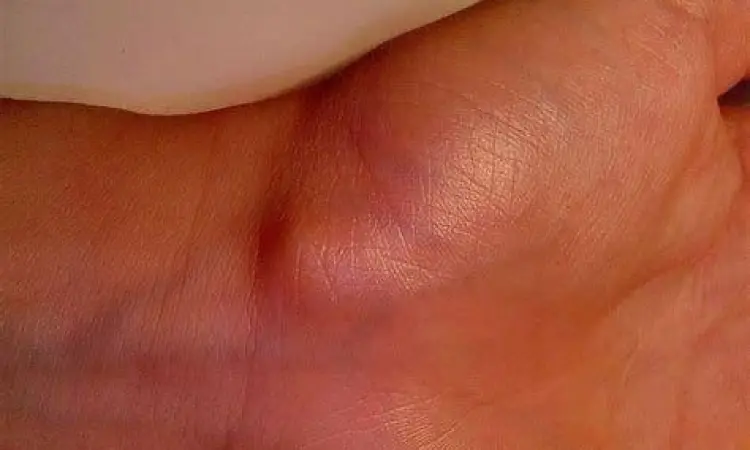 Kista Ganglion Benjolan kista ganglion pada tangan