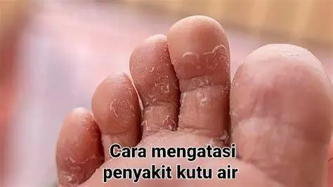 Infeksi Jamur Kaki Gejala infeksi kutu air pada sela jari kaki